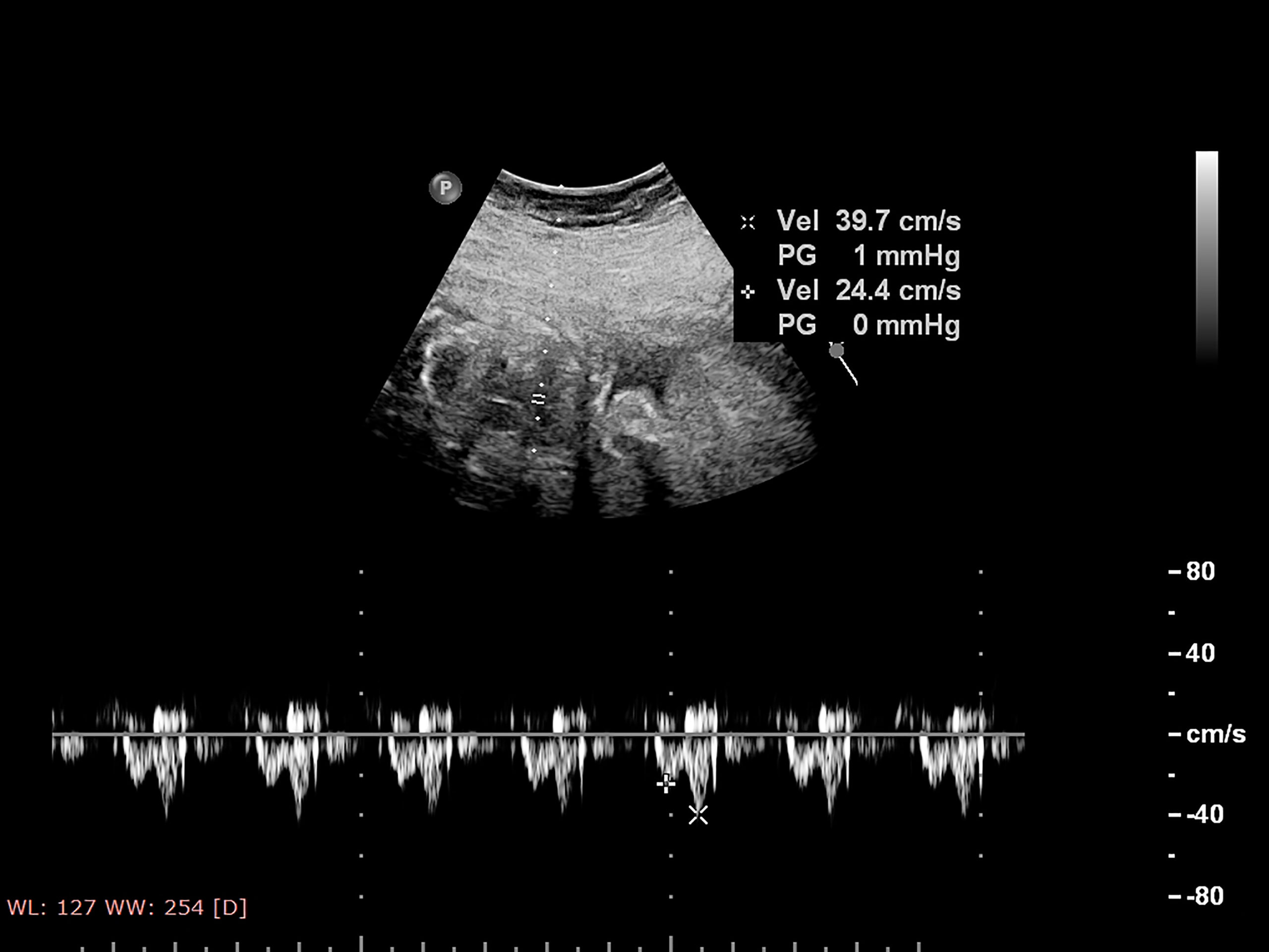 Análisis de señales de fonocardiografía fetal mediante un enfoque basado en procesamiento de señales y aprendizaje automático